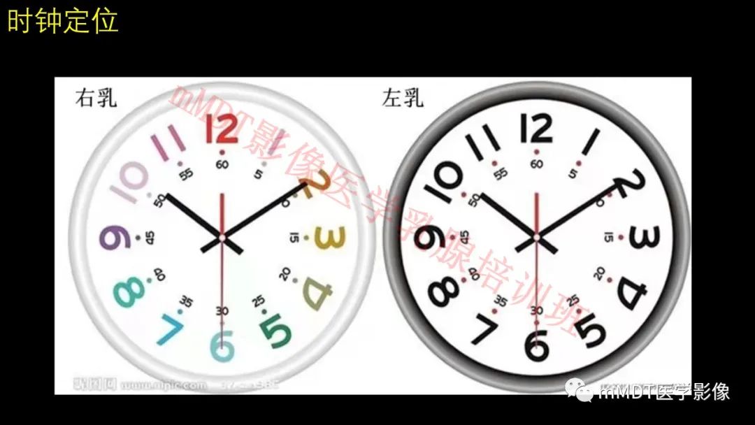 影像PPT - 【PPT】乳腺MRI诊断-28 影像PPT - 【PPT】乳腺MRI诊断-28