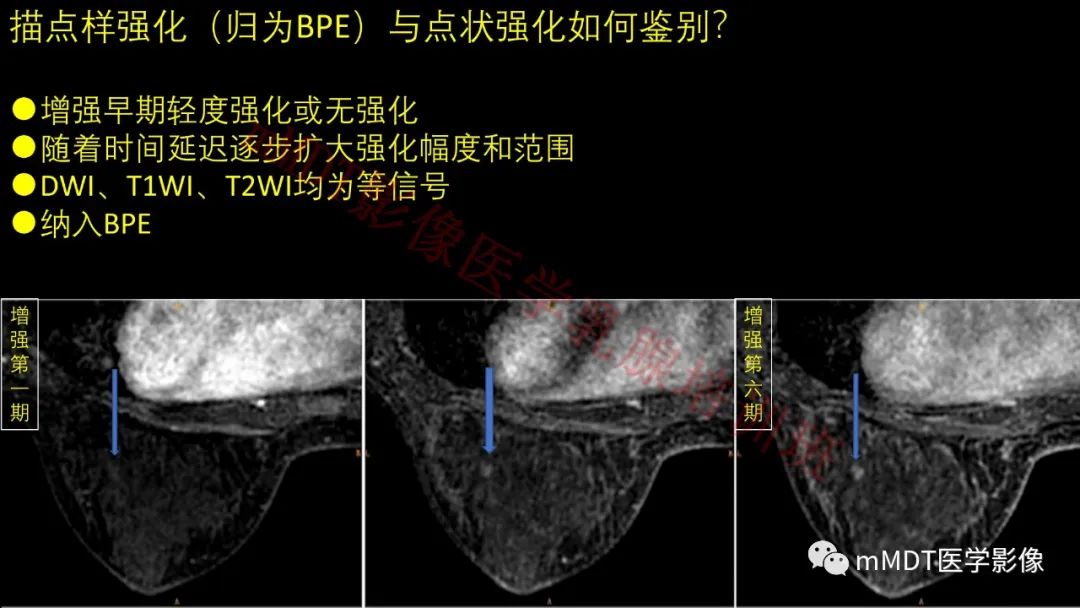 影像PPT - 【PPT】乳腺MRI诊断-33 影像PPT - 【PPT】乳腺MRI诊断-33