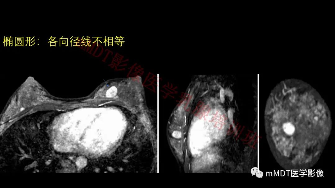 影像PPT - 【PPT】乳腺MRI诊断-38 影像PPT - 【PPT】乳腺MRI诊断-38