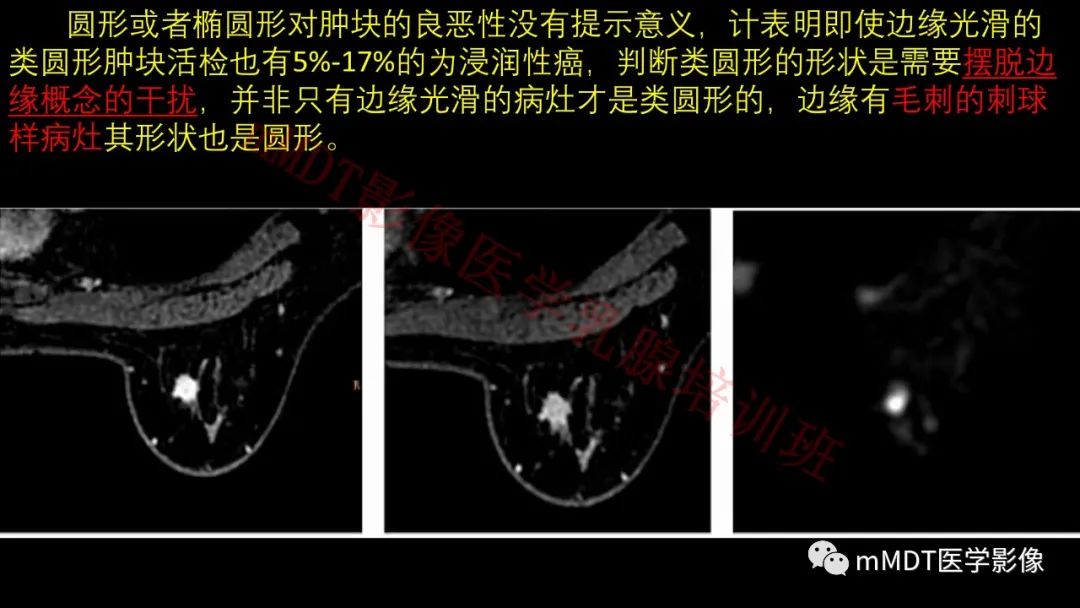 影像PPT - 【PPT】乳腺MRI诊断-40 影像PPT - 【PPT】乳腺MRI诊断-40