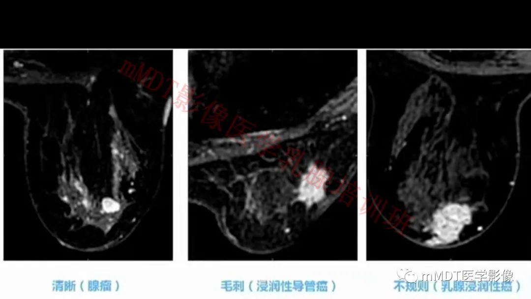 影像PPT - 【PPT】乳腺MRI诊断-45 影像PPT - 【PPT】乳腺MRI诊断-45