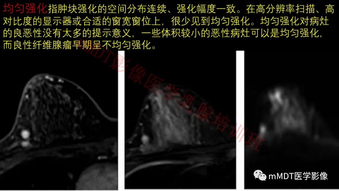 影像PPT - 【PPT】乳腺MRI诊断-47 影像PPT - 【PPT】乳腺MRI诊断-47