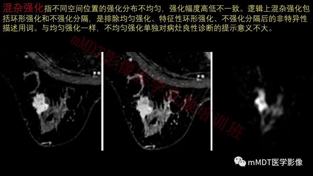 影像PPT - 【PPT】乳腺MRI诊断-48 影像PPT - 【PPT】乳腺MRI诊断-48