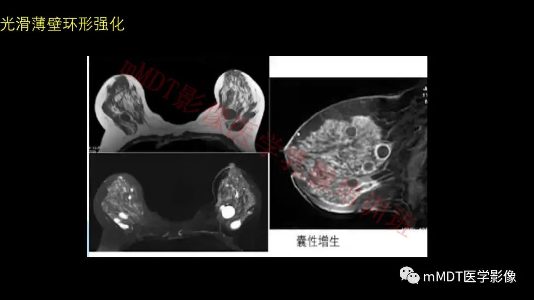 影像PPT - 【PPT】乳腺MRI诊断-50 影像PPT - 【PPT】乳腺MRI诊断-50