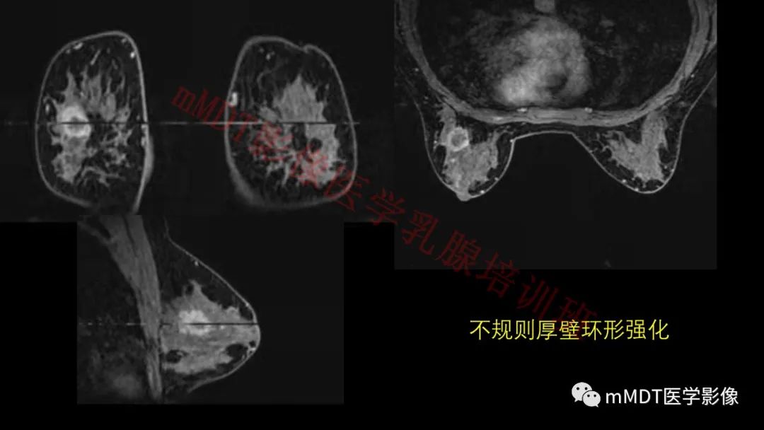 影像PPT - 【PPT】乳腺MRI诊断-52 影像PPT - 【PPT】乳腺MRI诊断-52
