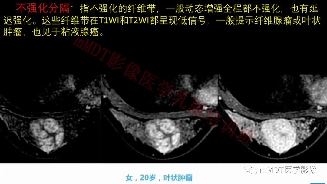 影像PPT - 【PPT】乳腺MRI诊断-53 影像PPT - 【PPT】乳腺MRI诊断-53