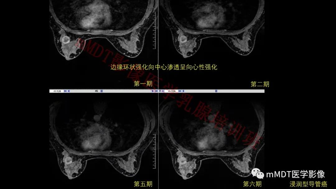 影像PPT - 【PPT】乳腺MRI诊断-55 影像PPT - 【PPT】乳腺MRI诊断-55