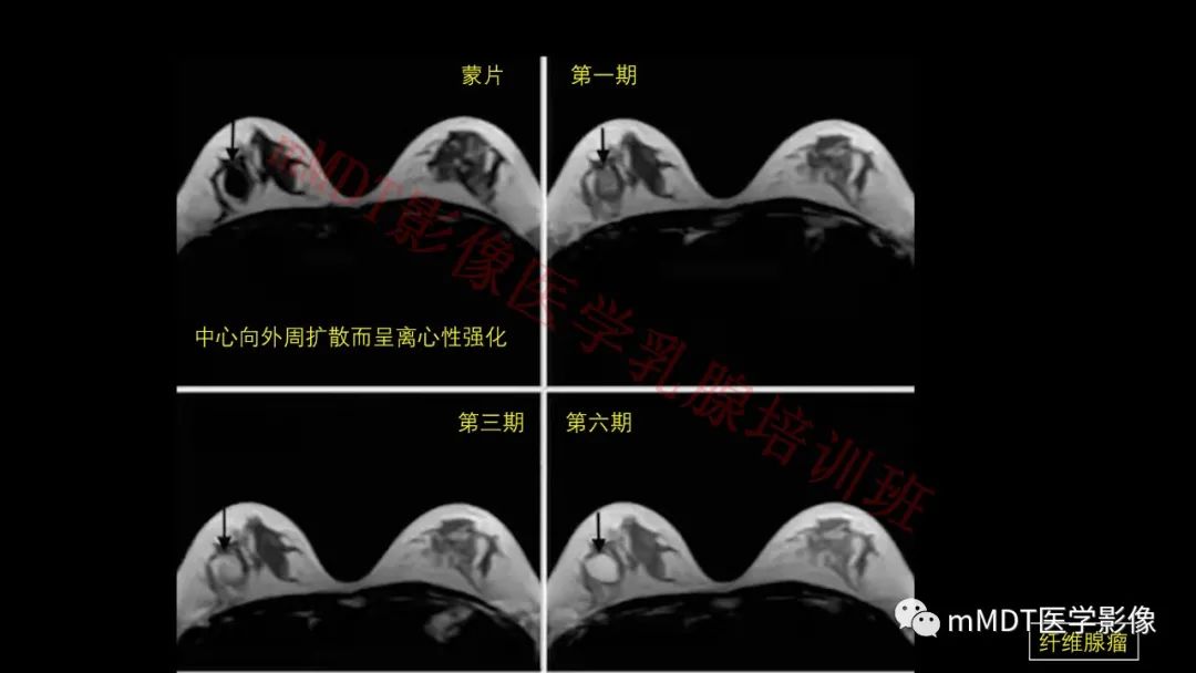 影像PPT - 【PPT】乳腺MRI诊断-56 影像PPT - 【PPT】乳腺MRI诊断-56