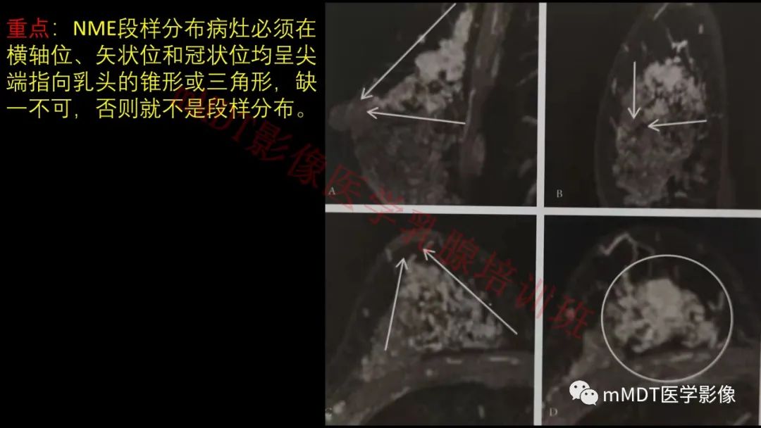 影像PPT - 【PPT】乳腺MRI诊断-60 影像PPT - 【PPT】乳腺MRI诊断-60