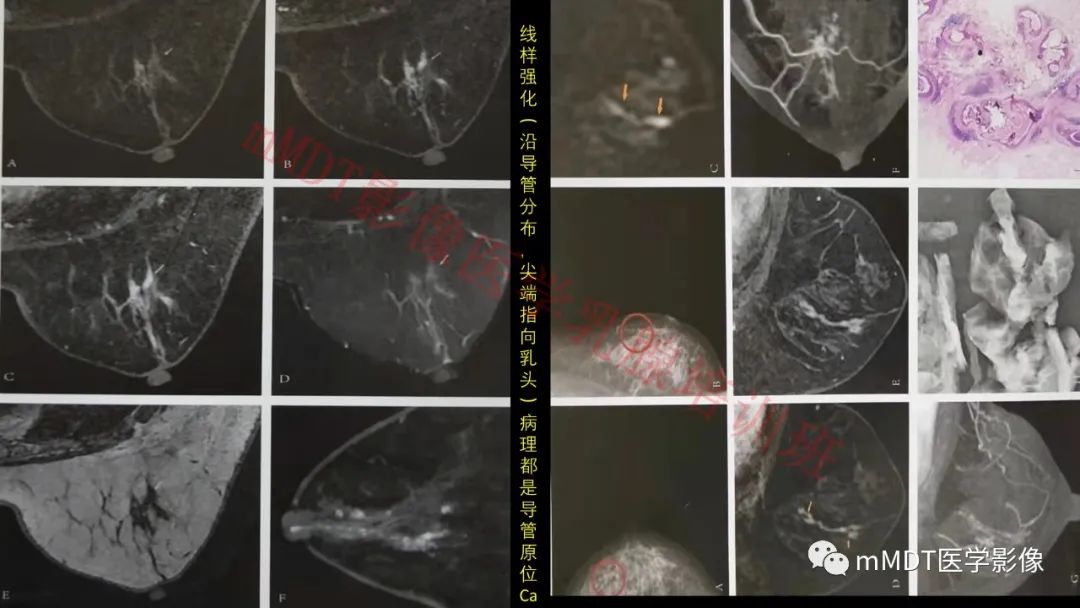 影像PPT - 【PPT】乳腺MRI诊断-62 影像PPT - 【PPT】乳腺MRI诊断-62