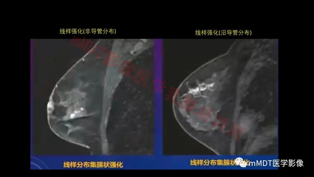 影像PPT - 【PPT】乳腺MRI诊断-63 影像PPT - 【PPT】乳腺MRI诊断-63