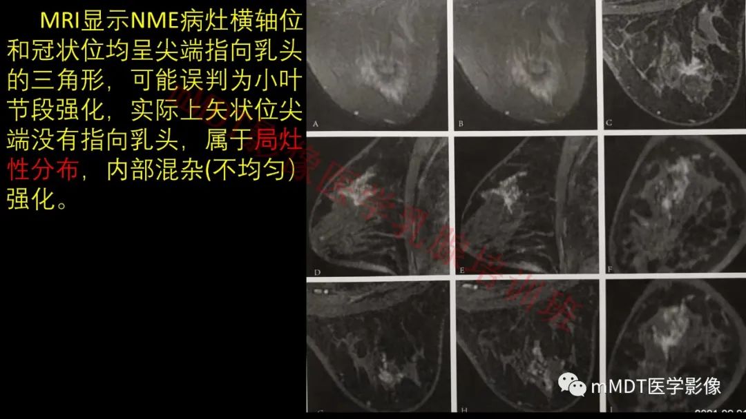 影像PPT - 【PPT】乳腺MRI诊断-65 影像PPT - 【PPT】乳腺MRI诊断-65