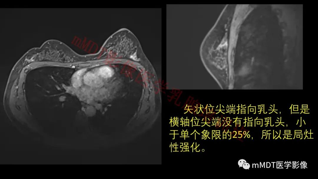 影像PPT - 【PPT】乳腺MRI诊断-66 影像PPT - 【PPT】乳腺MRI诊断-66