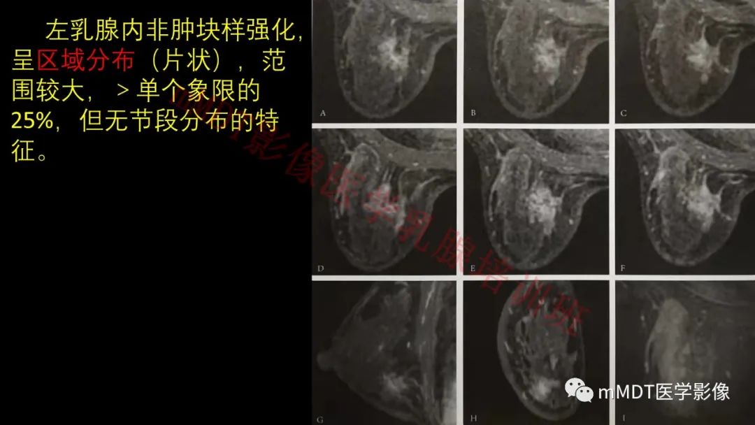 影像PPT - 【PPT】乳腺MRI诊断-67 影像PPT - 【PPT】乳腺MRI诊断-67