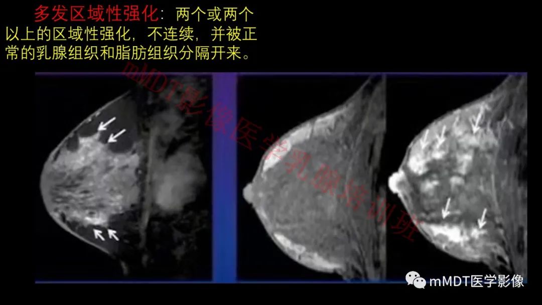 影像PPT - 【PPT】乳腺MRI诊断-68 影像PPT - 【PPT】乳腺MRI诊断-68