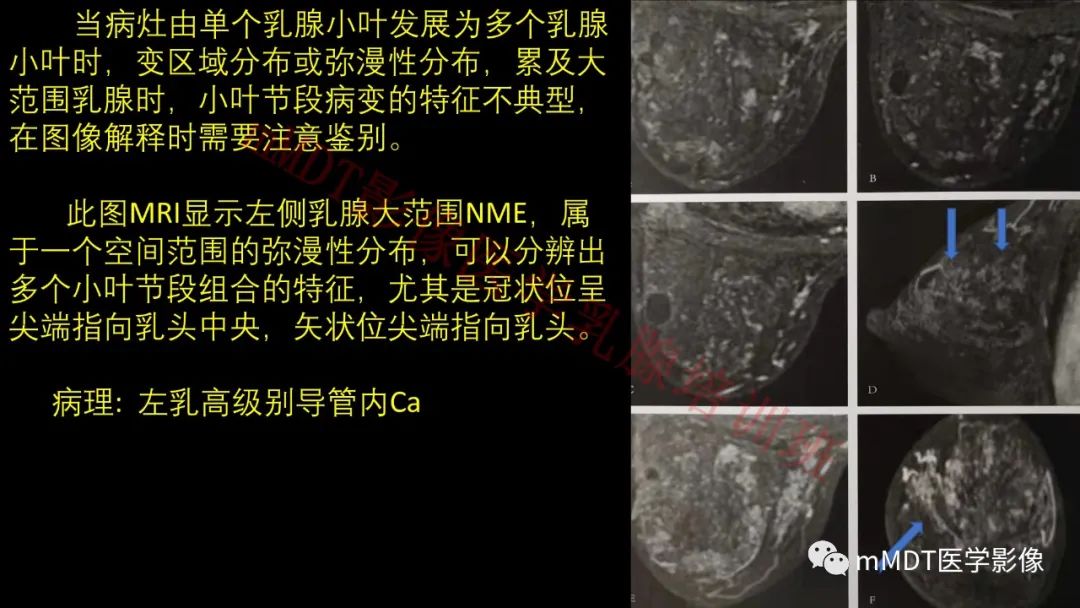 影像PPT - 【PPT】乳腺MRI诊断-69 影像PPT - 【PPT】乳腺MRI诊断-69