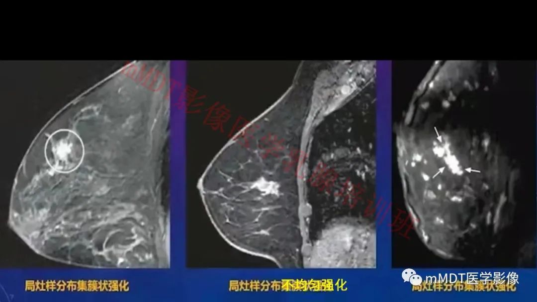 影像PPT - 【PPT】乳腺MRI诊断-73 影像PPT - 【PPT】乳腺MRI诊断-73