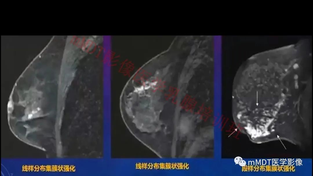 影像PPT - 【PPT】乳腺MRI诊断-74 影像PPT - 【PPT】乳腺MRI诊断-74