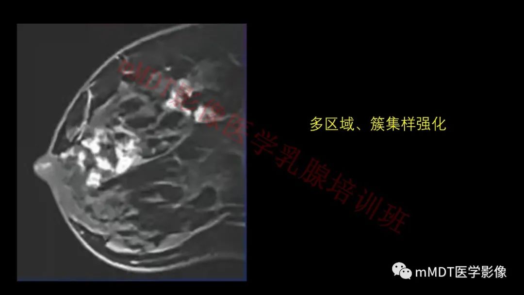 影像PPT - 【PPT】乳腺MRI诊断-75 影像PPT - 【PPT】乳腺MRI诊断-75