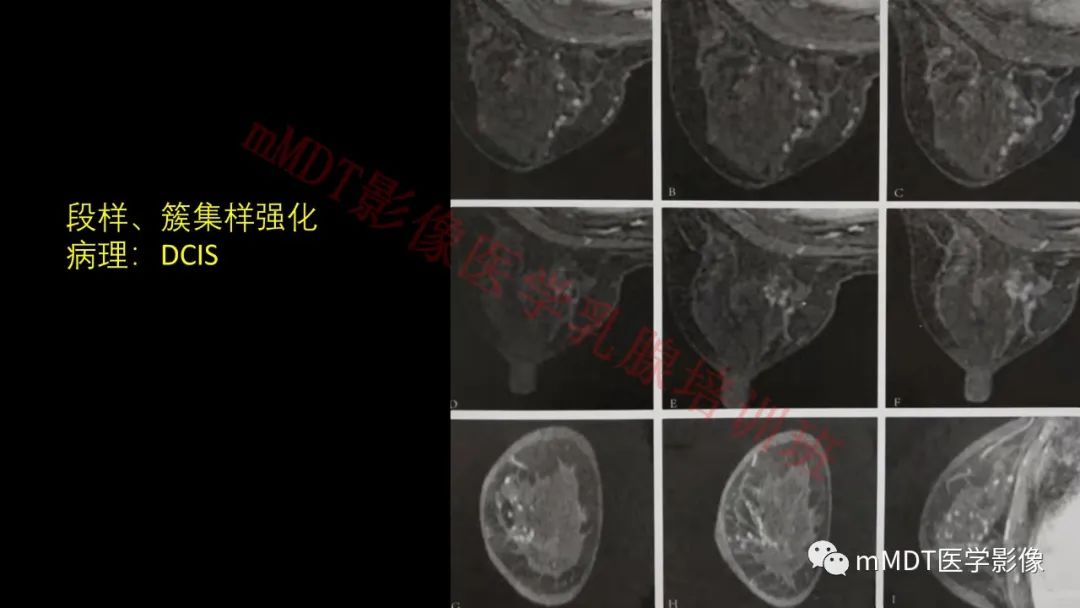 影像PPT - 【PPT】乳腺MRI诊断-76 影像PPT - 【PPT】乳腺MRI诊断-76