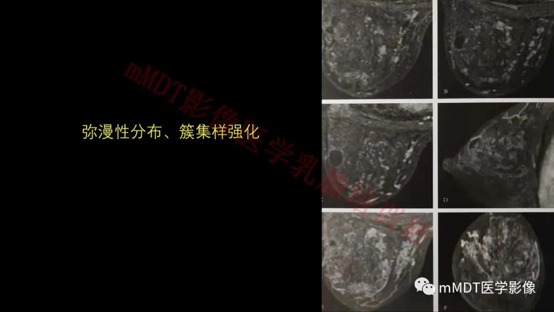 影像PPT - 【PPT】乳腺MRI诊断-77 影像PPT - 【PPT】乳腺MRI诊断-77