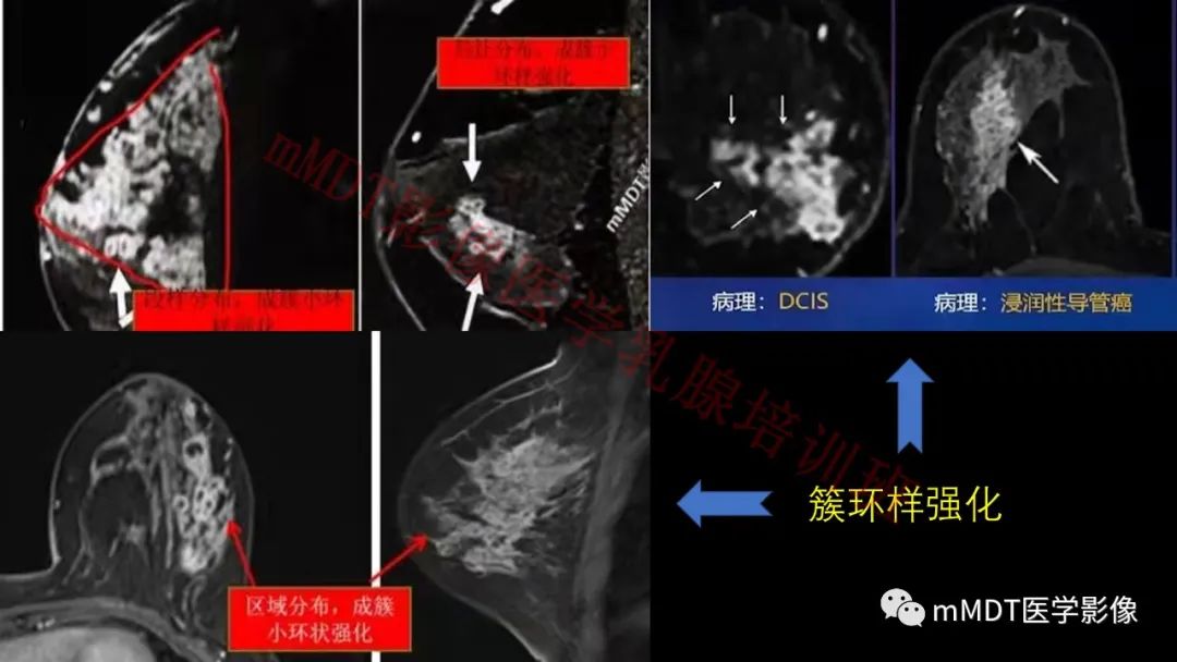 影像PPT - 【PPT】乳腺MRI诊断-80 影像PPT - 【PPT】乳腺MRI诊断-80