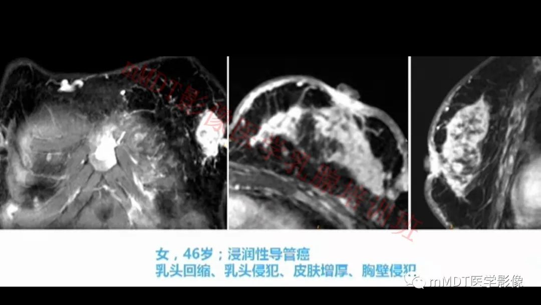 影像PPT - 【PPT】乳腺MRI诊断-83 影像PPT - 【PPT】乳腺MRI诊断-83