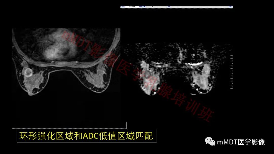 影像PPT - 【PPT】乳腺MRI诊断-89 影像PPT - 【PPT】乳腺MRI诊断-89