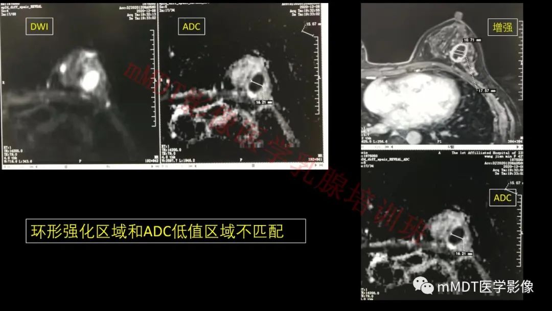 影像PPT - 【PPT】乳腺MRI诊断-90 影像PPT - 【PPT】乳腺MRI诊断-90