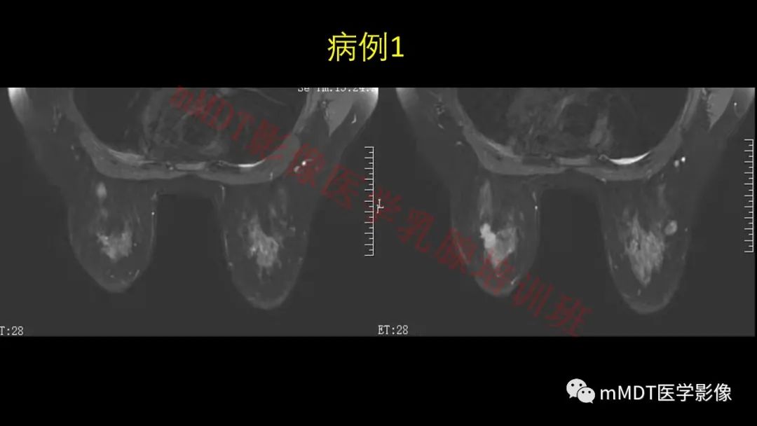 影像PPT - 【PPT】乳腺MRI诊断-102 影像PPT - 【PPT】乳腺MRI诊断-102