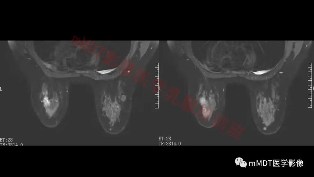影像PPT - 【PPT】乳腺MRI诊断-103 影像PPT - 【PPT】乳腺MRI诊断-103