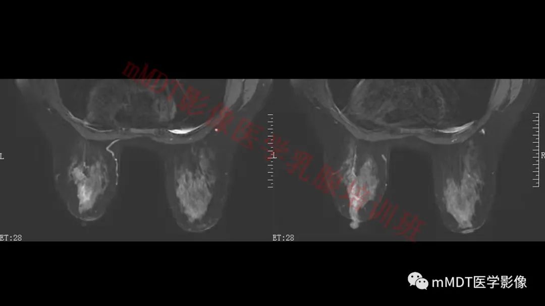 影像PPT - 【PPT】乳腺MRI诊断-104 影像PPT - 【PPT】乳腺MRI诊断-104