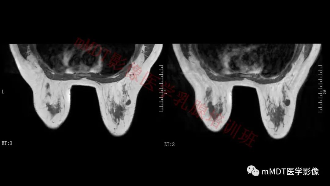 影像PPT - 【PPT】乳腺MRI诊断-105 影像PPT - 【PPT】乳腺MRI诊断-105