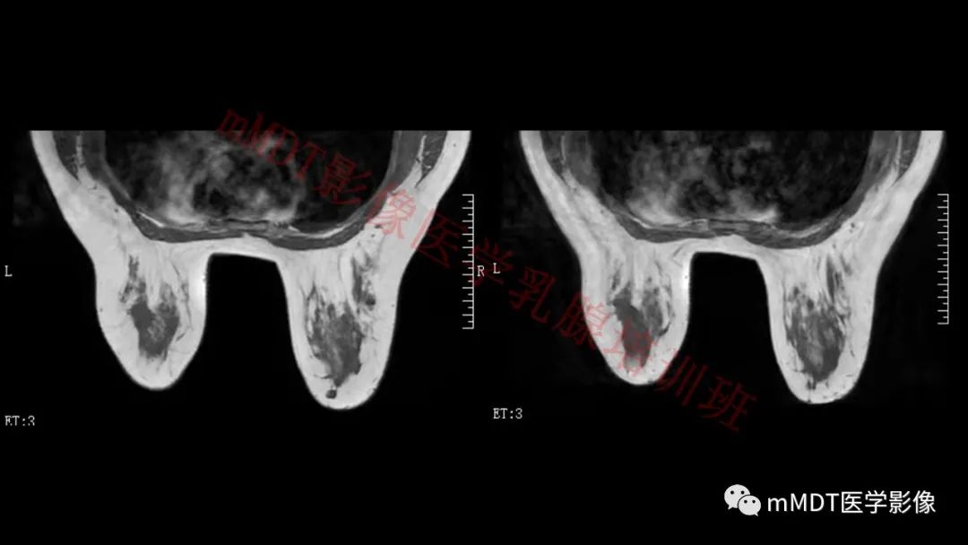 影像PPT - 【PPT】乳腺MRI诊断-106 影像PPT - 【PPT】乳腺MRI诊断-106
