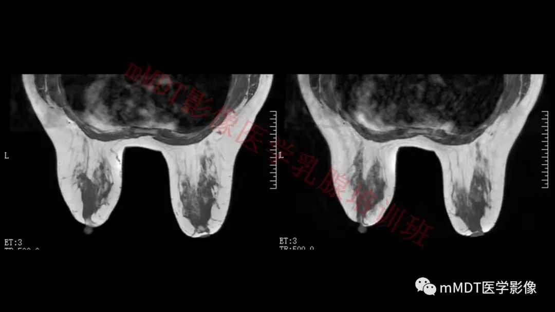 影像PPT - 【PPT】乳腺MRI诊断-107 影像PPT - 【PPT】乳腺MRI诊断-107