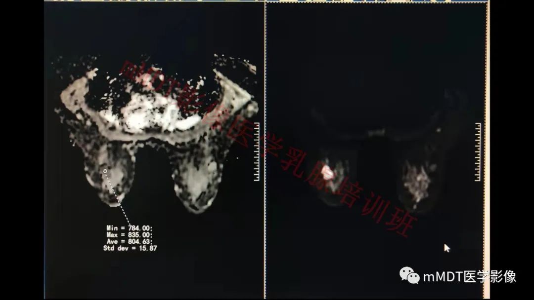影像PPT - 【PPT】乳腺MRI诊断-108 影像PPT - 【PPT】乳腺MRI诊断-108
