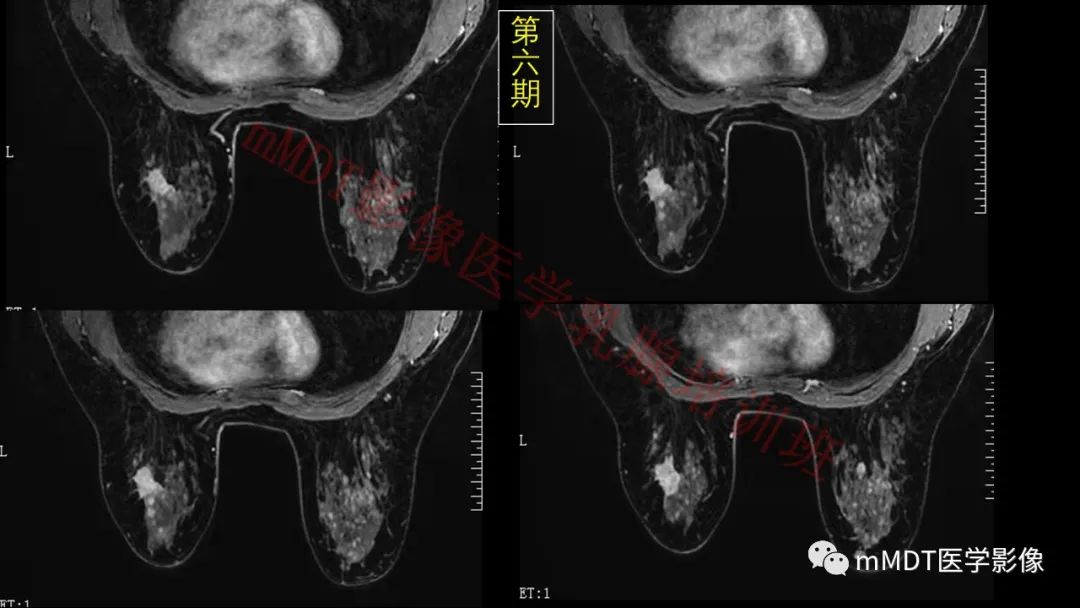 影像PPT - 【PPT】乳腺MRI诊断-112 影像PPT - 【PPT】乳腺MRI诊断-112