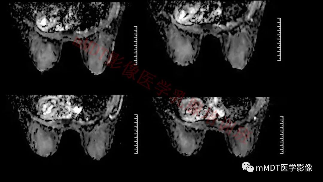 影像PPT - 【PPT】乳腺MRI诊断-121 影像PPT - 【PPT】乳腺MRI诊断-121