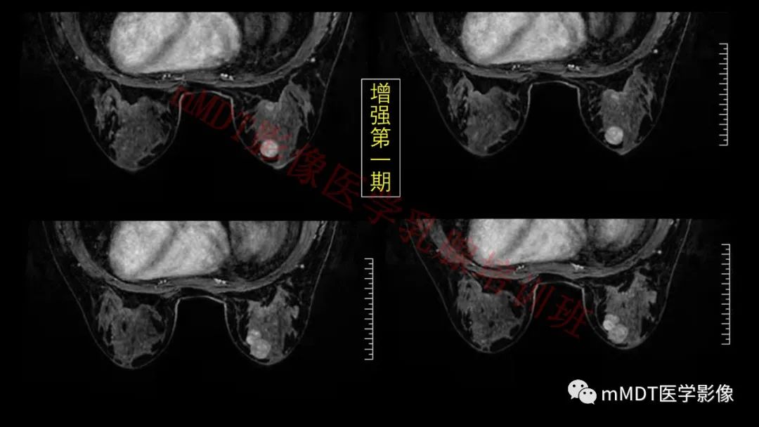 影像PPT - 【PPT】乳腺MRI诊断-123 影像PPT - 【PPT】乳腺MRI诊断-123