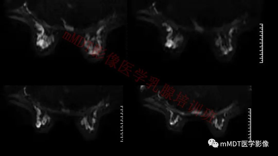 影像PPT - 【PPT】乳腺MRI诊断-131 影像PPT - 【PPT】乳腺MRI诊断-131