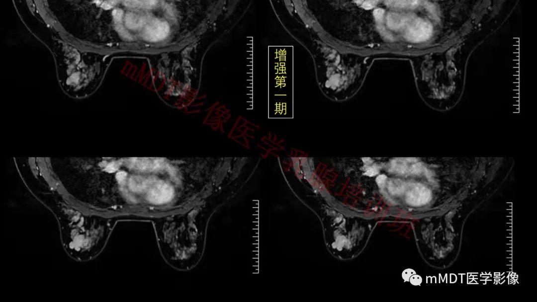 影像PPT - 【PPT】乳腺MRI诊断-134 影像PPT - 【PPT】乳腺MRI诊断-134