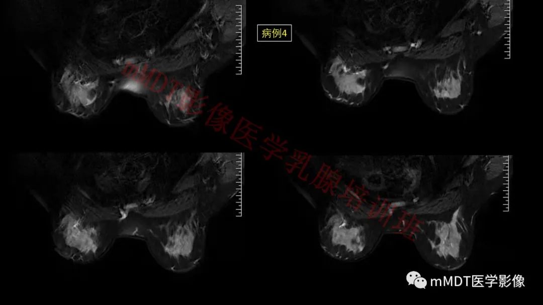 影像PPT - 【PPT】乳腺MRI诊断-141 影像PPT - 【PPT】乳腺MRI诊断-141