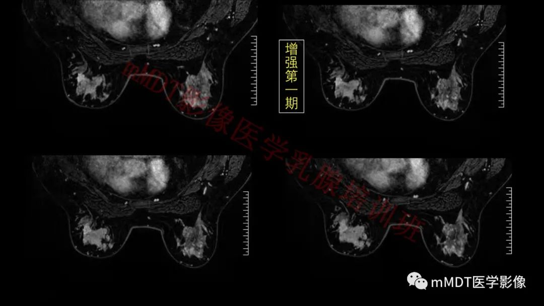 影像PPT - 【PPT】乳腺MRI诊断-147 影像PPT - 【PPT】乳腺MRI诊断-147