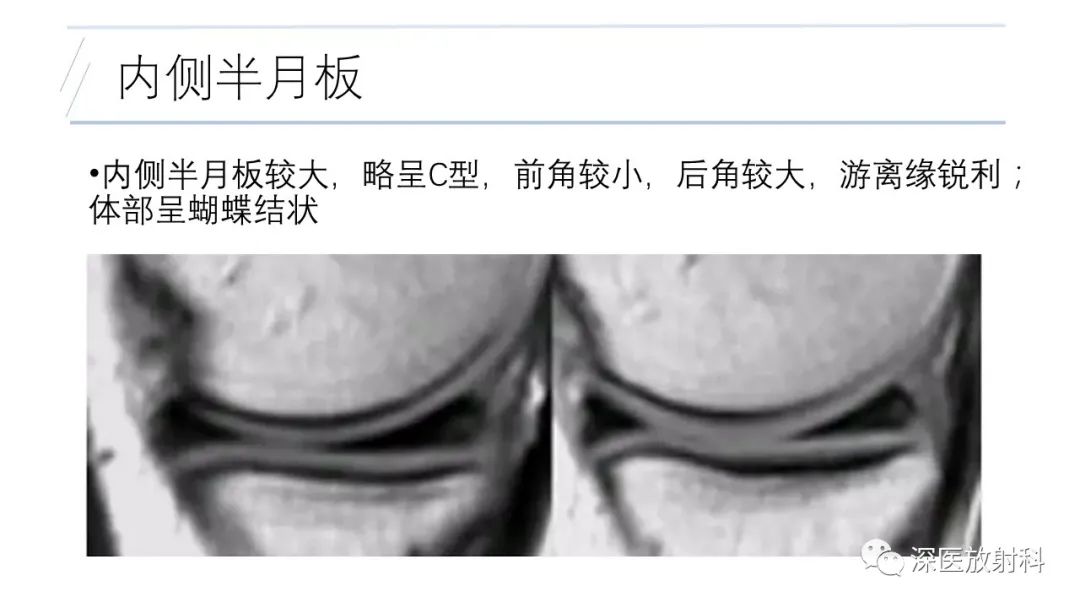 影像PPT - 【PPT】膝关节解剖变异的影像诊断-5