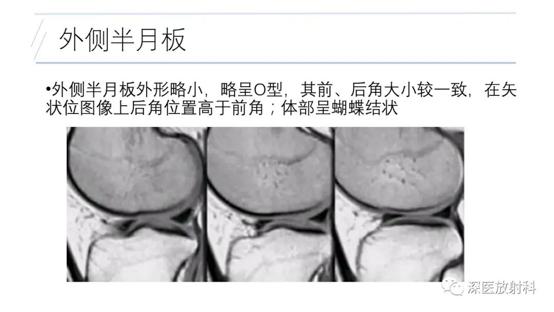 影像PPT - 【PPT】膝关节解剖变异的影像诊断-6
