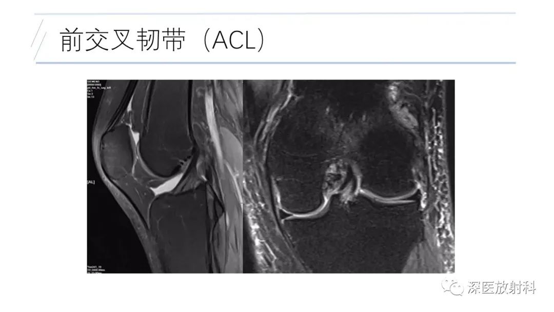 影像PPT - 【PPT】膝关节解剖变异的影像诊断-8