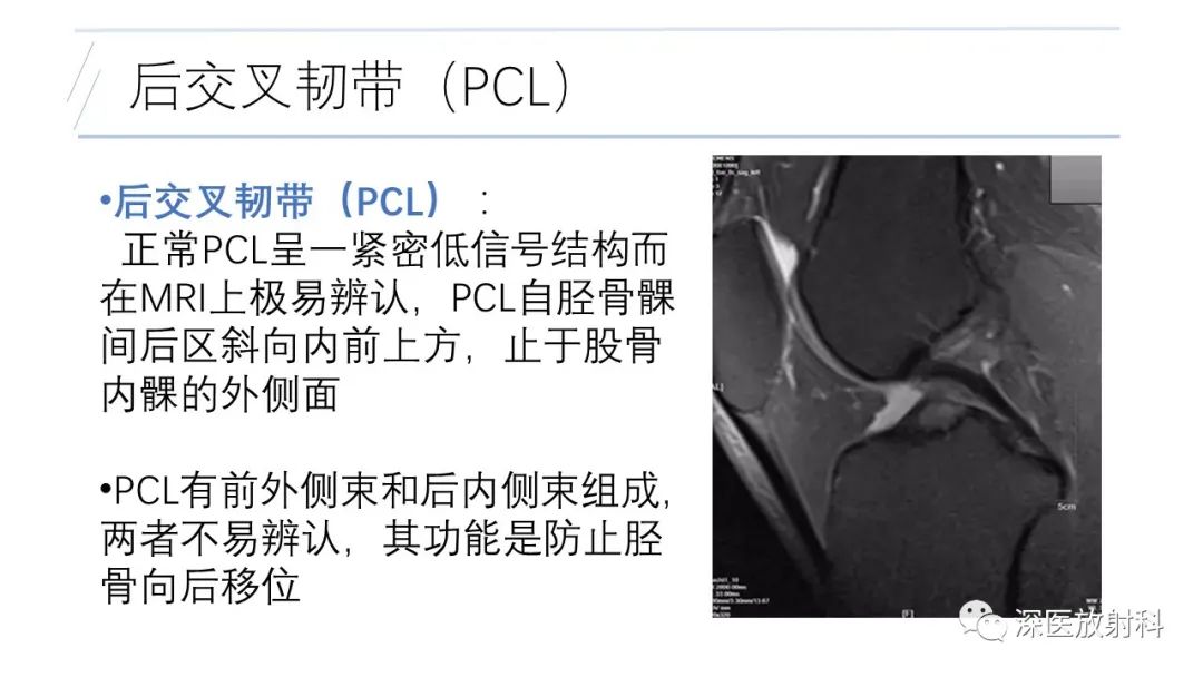 影像PPT - 【PPT】膝关节解剖变异的影像诊断-9