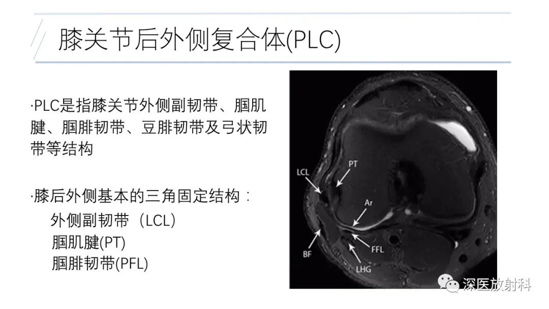 影像PPT - 【PPT】膝关节解剖变异的影像诊断-13