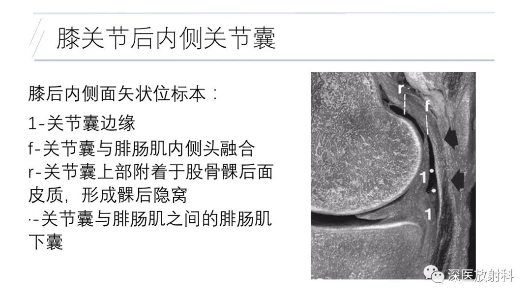 影像PPT - 【PPT】膝关节解剖变异的影像诊断-14