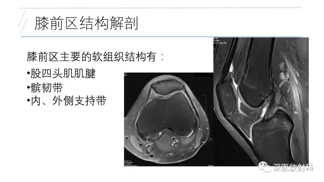影像PPT - 【PPT】膝关节解剖变异的影像诊断-15